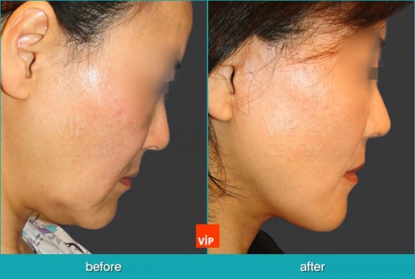 	Face Lift	 - High SMAS Face / Necklift