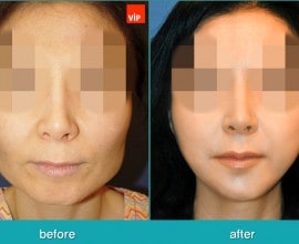 Face Contouring Surgery, V-line Jaw Reduction, Fat Graft, Ch…