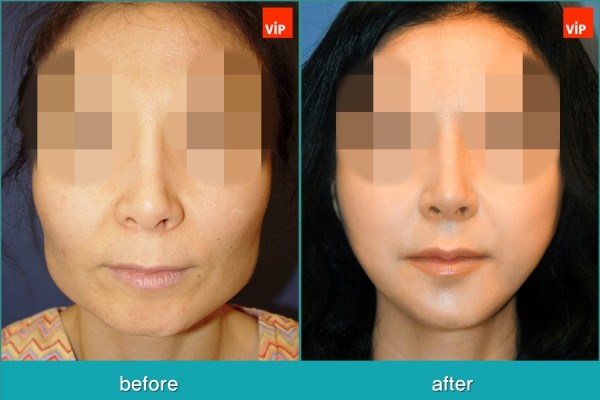 	Facial Bone Surgery, Fat graft	 - Face Contouring Surgery, V-line Jaw Reduction, Fat Graft, Cheekbone Reduction