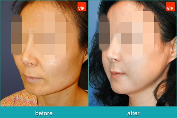 	Facial Bone Surgery, Fat graft	 - Face Contouring Surgery, V-line Jaw Reduction, Fat Graft, Cheekbone Reduction