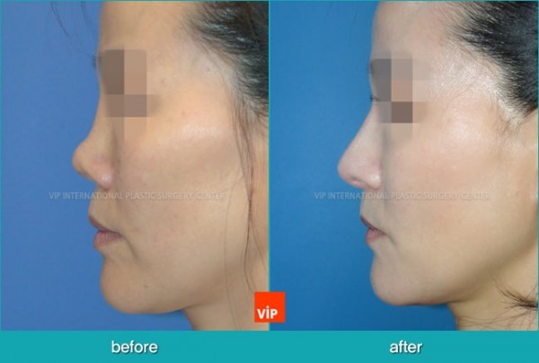 	Nose Surgery, Rib cartilage Rhinoplasty, Contracted Nose, Revision Rhinoplasty	 - Rib Cartilage Rhinoplasty