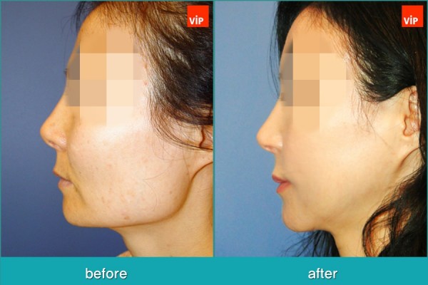 	Facial Bone Surgery, Fat graft	 - Face Contouring Surgery, V-line Jaw Reduction, Fat Graft, Cheekbone Reduction