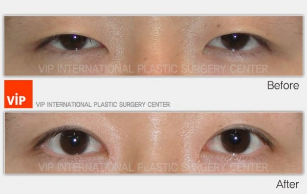 	Eye Surgery, Double Fold, Ptosis Correction	 - eyelid surgery