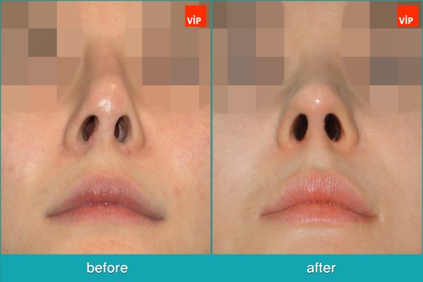 Nose Surgery - Rib cartilage Rhinoplasty