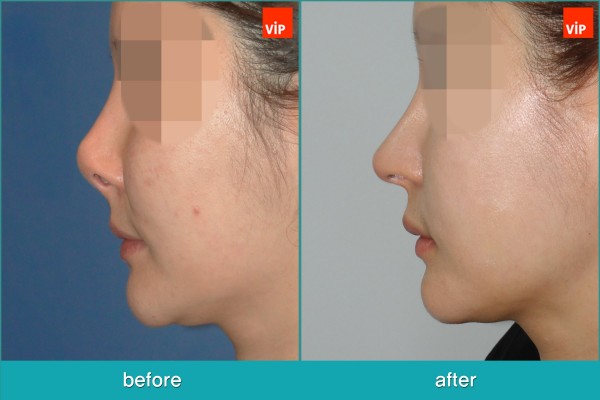 Nose Surgery - Rib cartilage Rhinoplasty