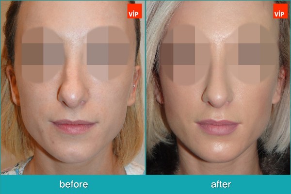 Nose Surgery - Septal Deviation