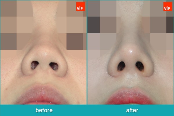 	Nose Surgery, Each Cases Nose, Septal Deviation	 - Septal Deviation