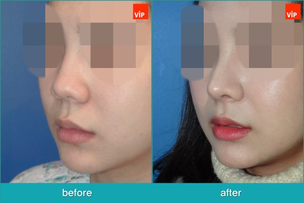 	Nose Surgery, Each Cases Nose, Septal Deviation	 - Septal Deviation