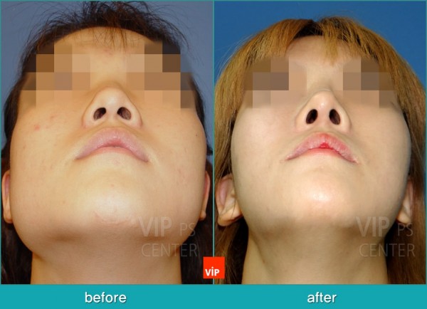 	Each Cases Nose, Septal Deviation	 - Septal Deviation