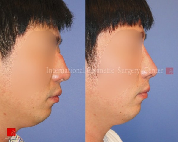 	Protruded Mouth Correction Rhinoplasty, Contracted Nose, Revision Rhinoplasty	 - 2nd Op. - Rib cartilage rhinoplasty