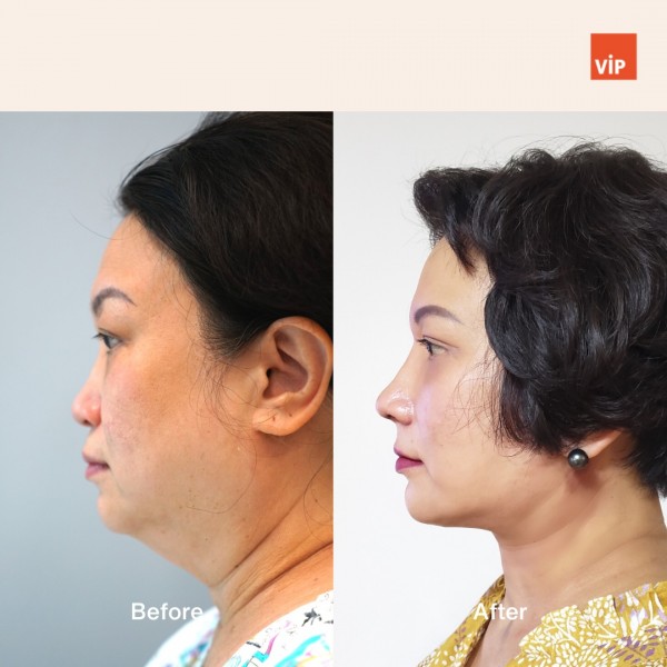 Nose Surgery, Face Lift - Deep Plane Facelift, Neck lift, & Rib Cartilage Rhinoplasty