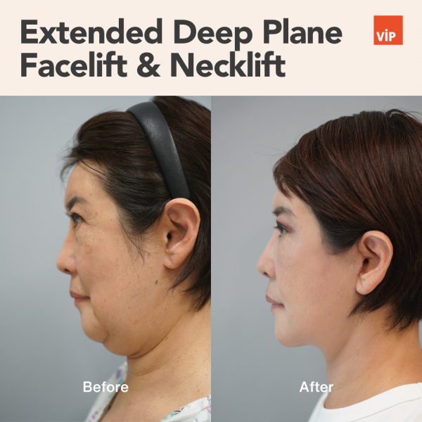 Face Lift - Extended Deep Plane Facelift & Necklift