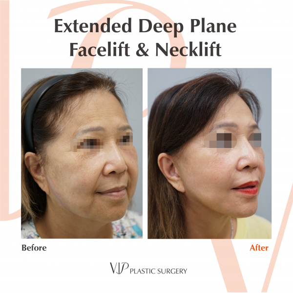 Face Lift - Extended Deep Plane Facelift & Necklift