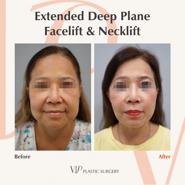 Face Lift - Extended Deep Plane Facelift & Necklift