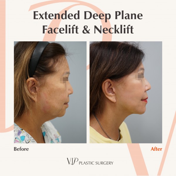 Face Lift - Extended Deep Plane Facelift & Necklift