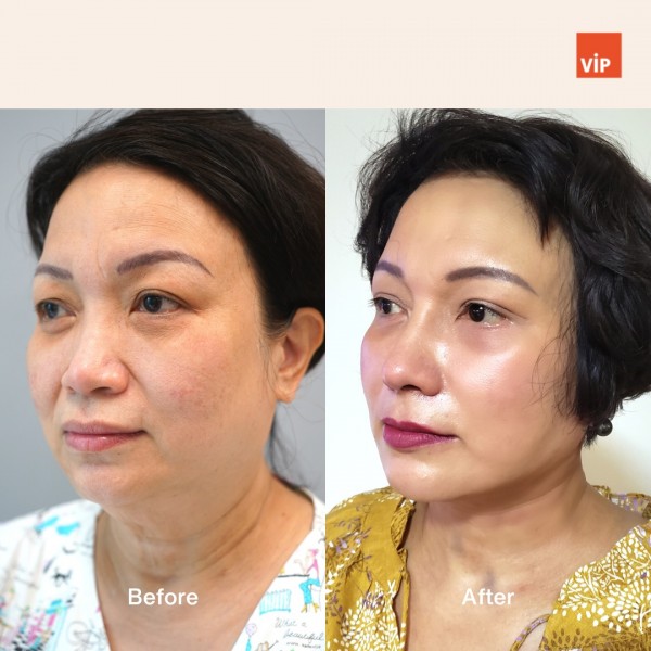 Nose Surgery, Face Lift - Deep Plane Facelift, Neck lift, & Rib Cartilage Rhinoplasty