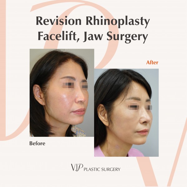 Nose Surgery, Face Lift, Body Contouring - Revision Rhinoplasty, Facelift, Jaw Surgery