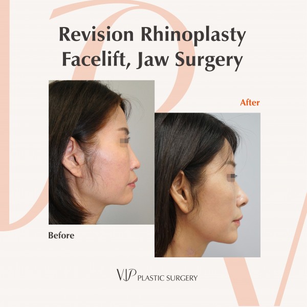 Nose Surgery, Face Lift, Body Contouring - Revision Rhinoplasty, Facelift, Jaw Surgery