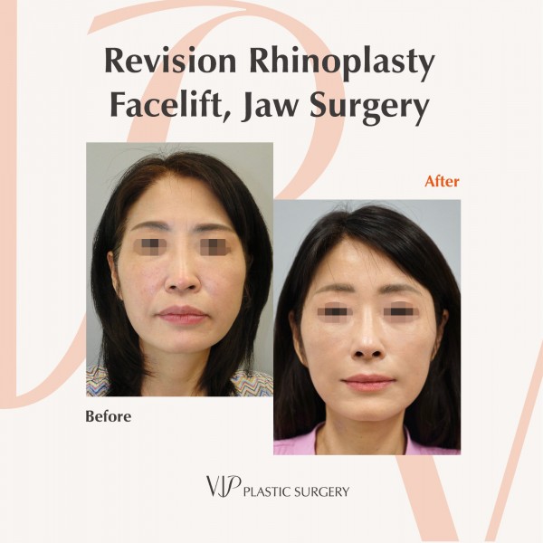 korean plastic surgery before and after jaw