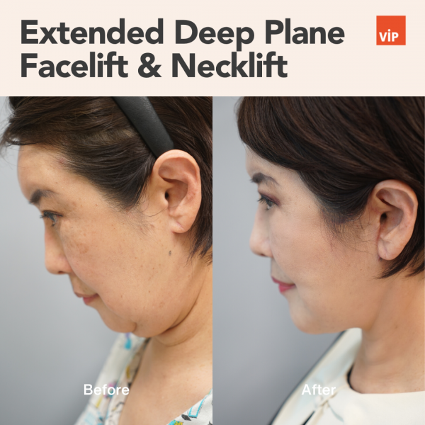 Face Lift - Extended Deep Plane Facelift & Necklift