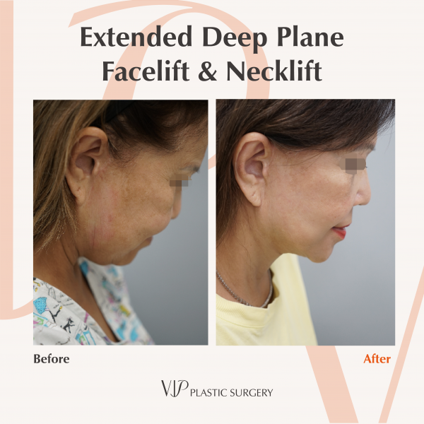 Face Lift - Extended Deep Plane Facelift & Necklift