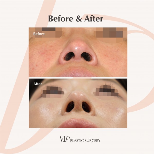 Nose Surgery, Face Lift, Body Contouring - Revision Rhinoplasty, Facelift, Jaw Surgery