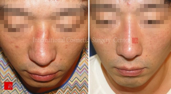 	Protruded Mouth Correction Rhinoplasty, Contracted Nose, Revision Rhinoplasty	 - 2nd Op. - Rib cartilage rhinoplasty