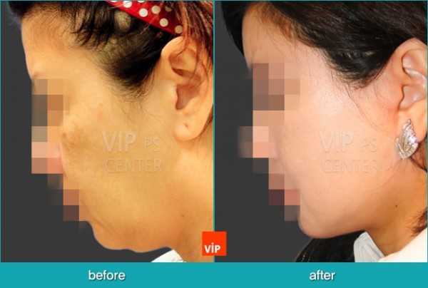 	Face Lift	 - High SMAS Face / Neck Lift with Dermis graft