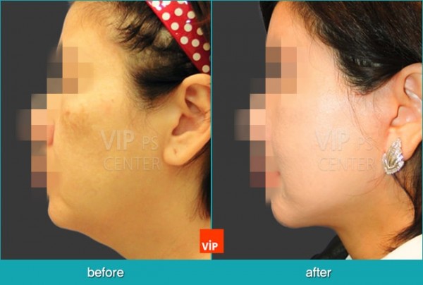 	Face Lift	 - High SMAS Face / Neck Lift with Dermis graft