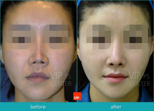 	Nose Surgery, Harmony-Rhinoplasty, Rib cartilage Rhinoplasty, Contracted Nose, Revision Rhinoplasty	 - Rib Cartilage Rhinoplasty