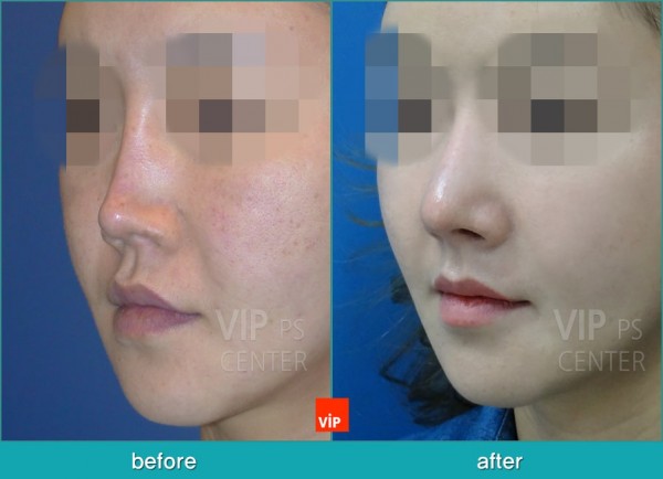 	Nose Surgery, Harmony-Rhinoplasty, Rib cartilage Rhinoplasty, Contracted Nose, Revision Rhinoplasty	 - Rib Cartilage Rhinoplasty