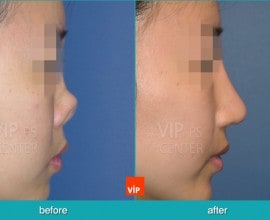 Reconstructed nose by rib cartilage rhinoplasty