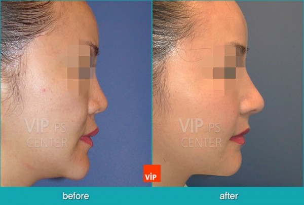 	Nose Surgery, Rib cartilage Rhinoplasty, Contracted Nose, Revision Rhinoplasty, Septal Deviation	 - Short nose Revision with Rib cartilage rhinoplasty