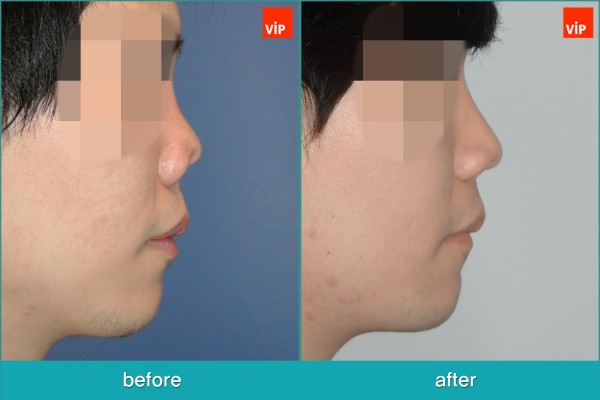 	Nose Surgery, Rib cartilage Rhinoplasty, Contracted Nose, Revision Rhinoplasty, Each Cases Nose	 - Revision rhinoplasty