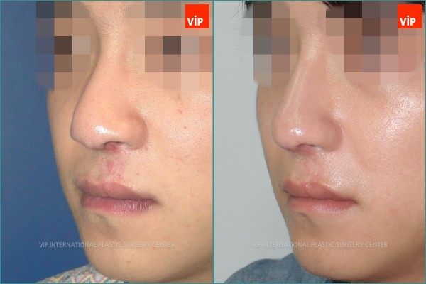 	Nose Surgery, Each Cases Nose	 - cleft lip nose surgery
