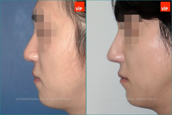 	Nose Surgery, Each Cases Nose	 - cleft lip nose surgery