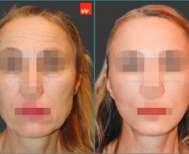 High SMAS Face / Neck Lift