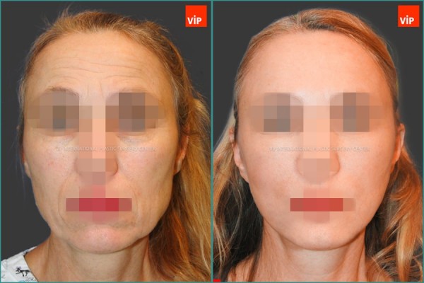 	Face Lift	 - High SMAS Face / Neck Lift