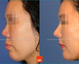 Rib Cartilage Rhinoplasty