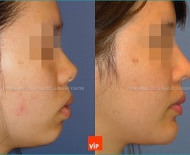 Protruded Mouth Correction by Rhinoplasty, Genioplasty