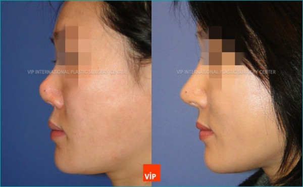 	Nose Surgery, Harmony-Rhinoplasty, Rib cartilage Rhinoplasty, Revision Rhinoplasty	 - Harmony Rhinoplasty