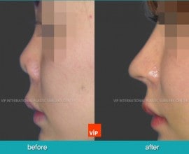 Post infection contracted nose correction with rib cartilage…