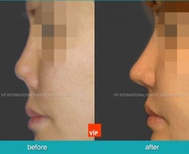 Post infection contracted nose correction with rib cartilage…