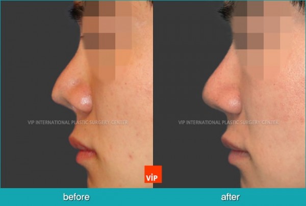 	Nose Surgery, Contracted Nose, Revision Rhinoplasty, Septal Deviation	 - Cleft Nose Deformity Correction