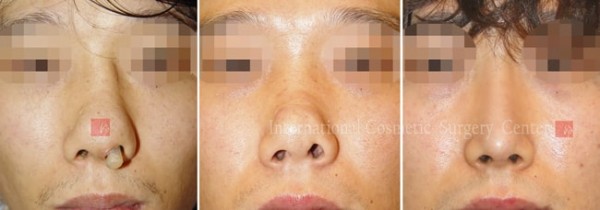 	Protruded Mouth Correction Rhinoplasty, Contracted Nose, Revision Rhinoplasty	 - Silicone showing/infection