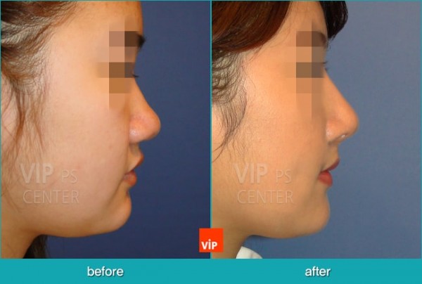 	Nose Surgery, Harmony-Rhinoplasty, Contracted Nose, Each Cases Nose	 - Bulbous nose - Harmony Rhinoplasty