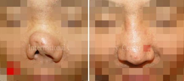 	Nose Surgery, Rib cartilage Rhinoplasty, Revision Rhinoplasty	 - Collapsed nose due to silicone infection
