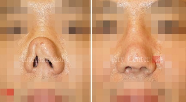 	Nose Surgery, Rib cartilage Rhinoplasty, Revision Rhinoplasty	 - Collapsed nose due to silicone infection