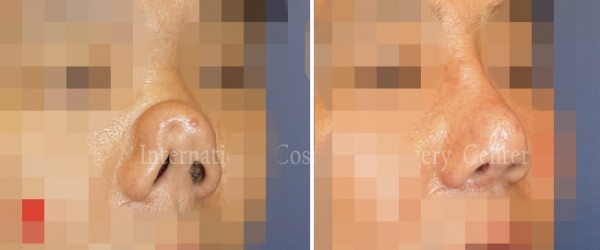 	Nose Surgery, Rib cartilage Rhinoplasty, Revision Rhinoplasty	 - Collapsed nose due to silicone infection