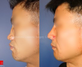 Flat nose correction with Rib cartilage (collapsed due to fa…
